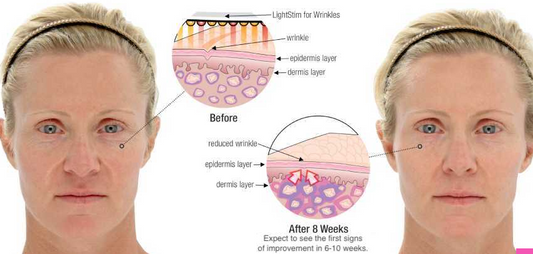 LightStim for Wrinkles