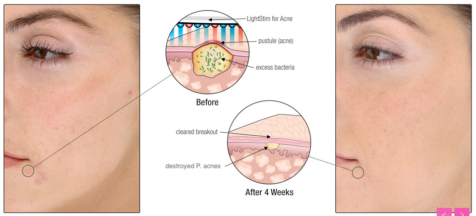 LightStim For Acne